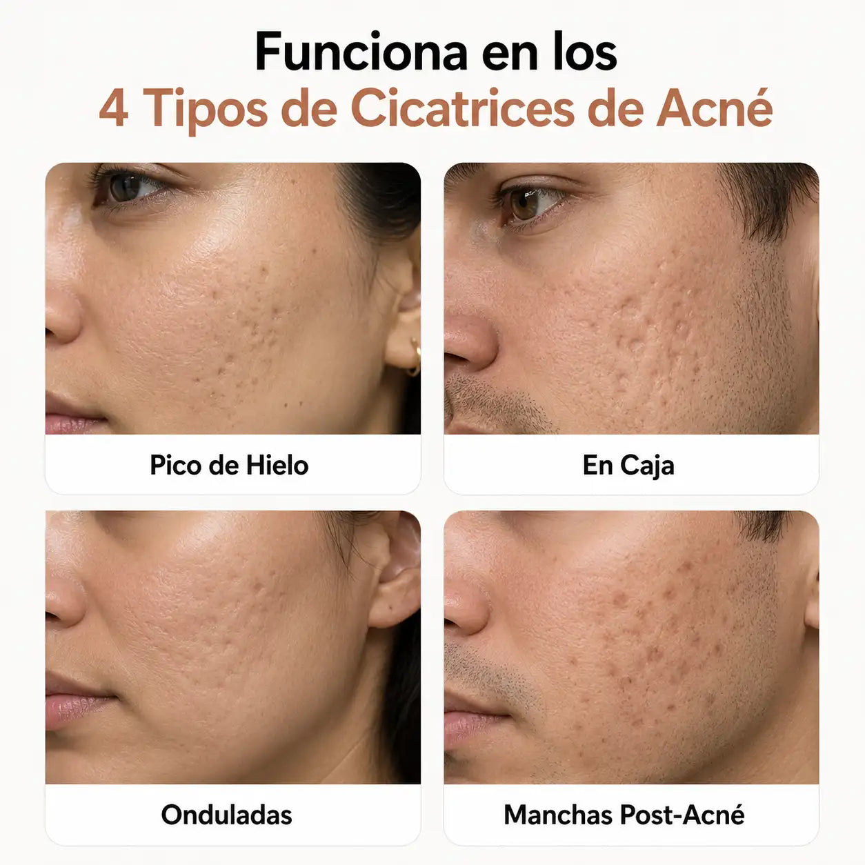 Stick Reparador de Cicatrices de Acné: Con silicona médica al 64% que aplana, suaviza y aclara las marcas que dejó el acné en tu piel.