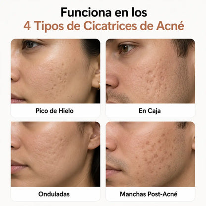Stick Reparador de Cicatrices de Acné: Con silicona médica al 64% que aplana, suaviza y aclara las marcas que dejó el acné en tu piel.